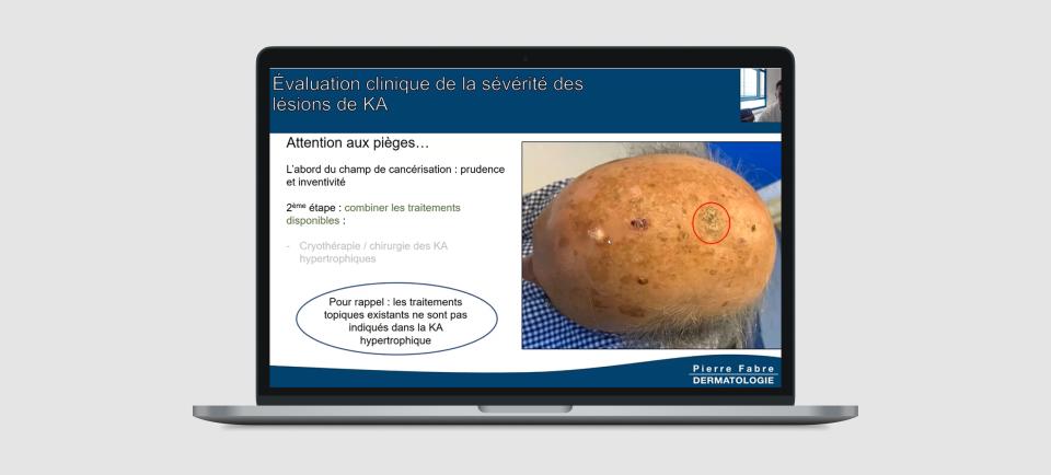 Diagnostic et prise en charge de la Kératose actinique